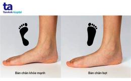 chân bẹt